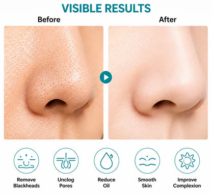 Blueidea Blackhead Remover Vacuum – Electric Facial Pore Cleaner