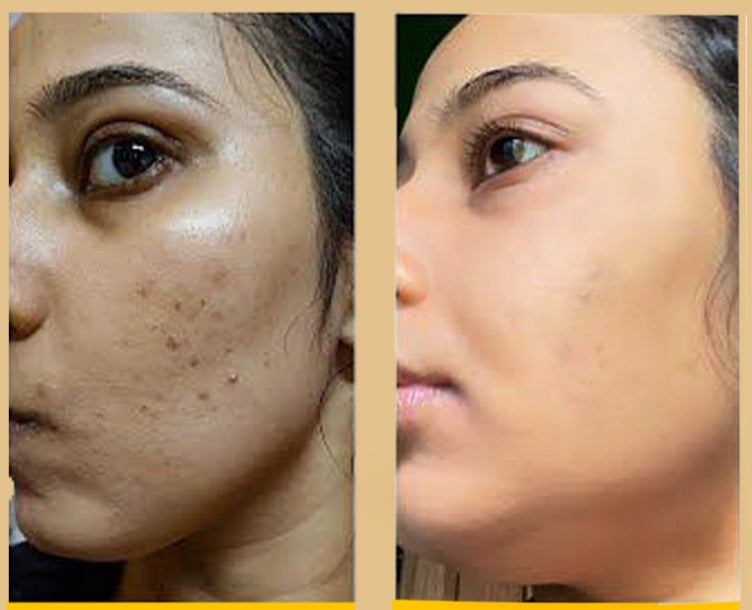 AHR Skin Lifting Device ( Collagen Support )